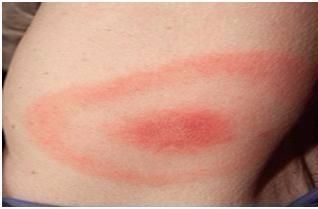 Could Lyme Disease Be the Cause of Your Health Condition?