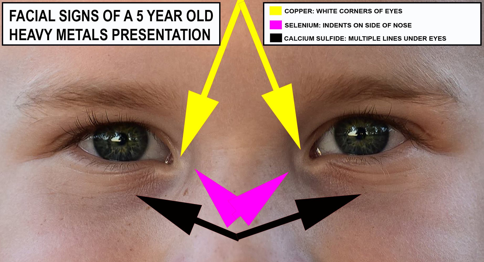 Heavy Metal Toxicity Facial Signs in Children