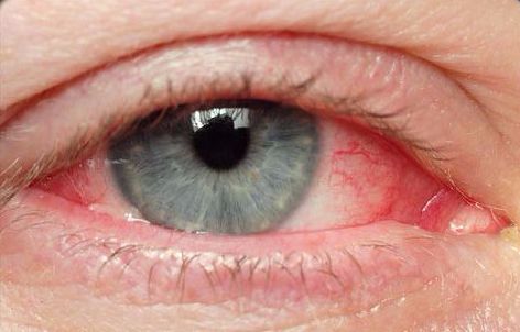 Remedy for Bloodshot Eyes