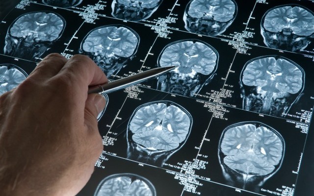 Fact: Aluminum leads to neurodegenerative or autoimmune disease
