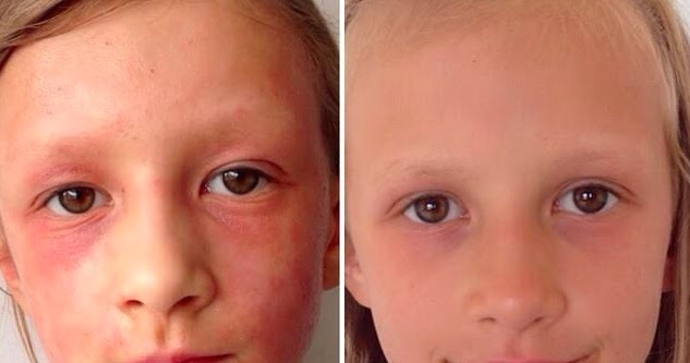 HEALED:  Eczema & Allergies